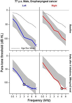 Serial monitoring of the audiogram in hearing conservation using Gaussian processes